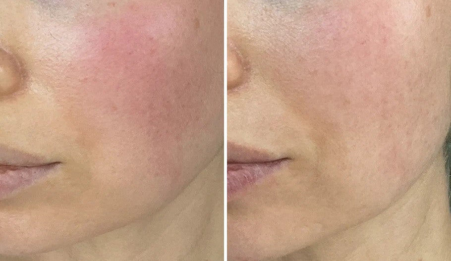 How to Calm Rosacea Naturally: Start with Skin Nutrient Australia and Support from Niche Café Biotics